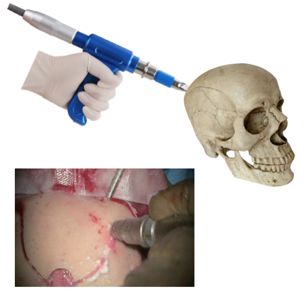 自?？焖匍_顱鉆